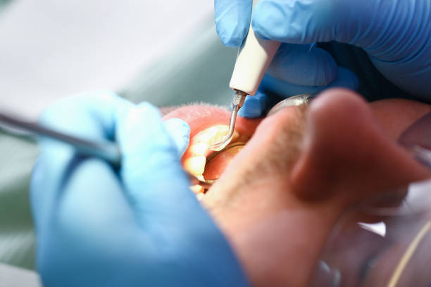 Best Emergency Wisdom Tooth Extraction in Cape Carteret, NC